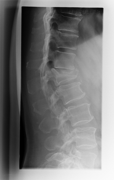 lateral TL spine
