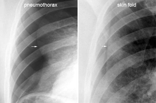 pneumothorax vs skinfold