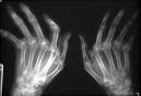 Rheumatoid Arthritis - wikiRadiography