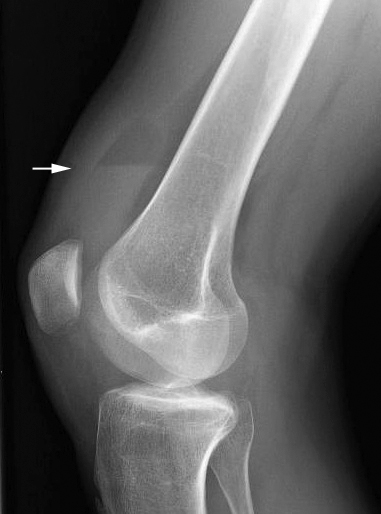 erect lateral knee lipohaemarthrosis
