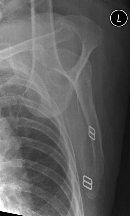 lat scap dislocated shoulder