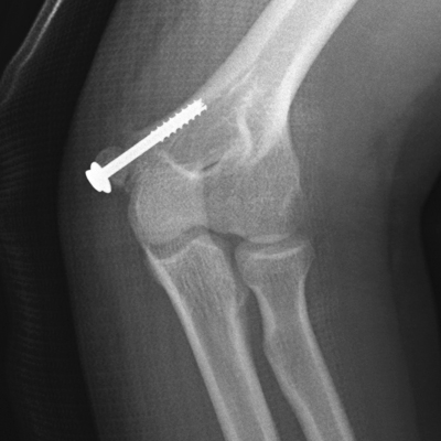 medial epicondyle fracture post fixation