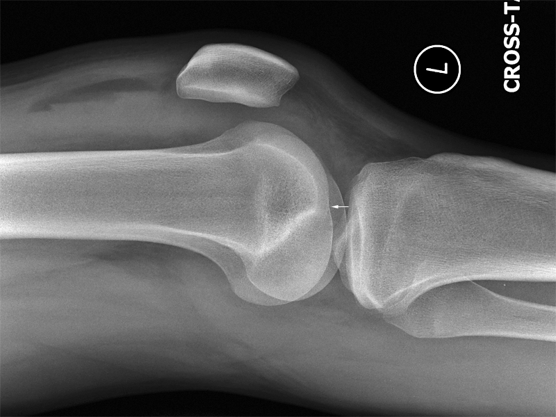 Lateral Knee Radiography Wikiradiography