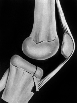 tibial tuberosity fracture type 1