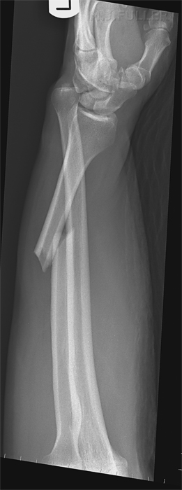 Galeazzi fracture-dislocation
