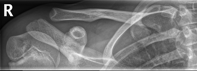 normal 13 year old male ap clavicle
