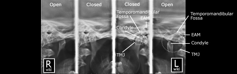 Temporomandibular Joints (TMJ) Radiographic Anatomy - wikiRadiography