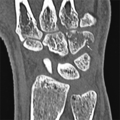 hamate fracture CT