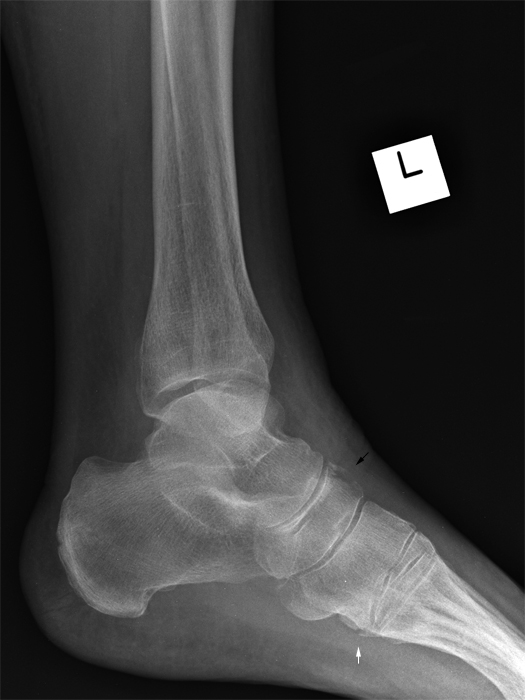 5th MT fracture