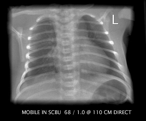 The Supine Pneumothorax - wikiRadiography