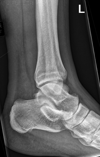 LATERAL ANKLE