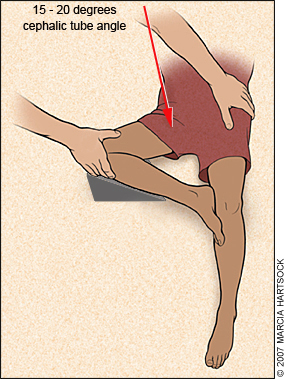 modified lateral hip technique