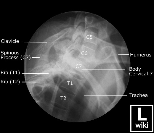 Radiographic Anatomy - Cervical Spine Swimmers