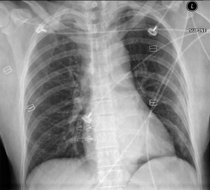Supine Pneumothorax Self-test Page - wikiRadiography