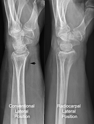 radiocarpal lateral wrist