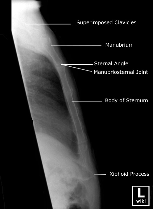 Radiographic Anatomy - Sternum Lateral