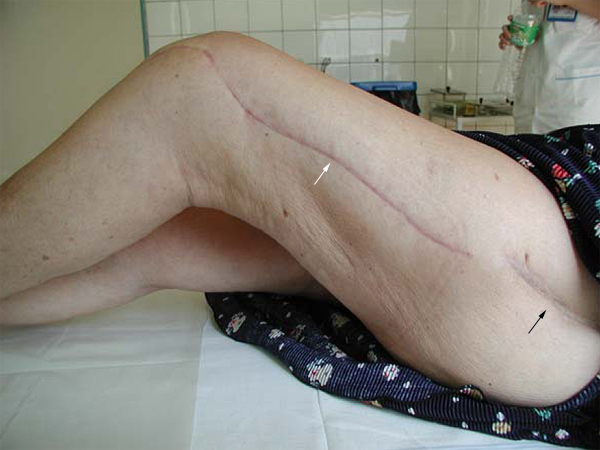 hip replacement surgery scar