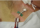 Dialysis Catheter (Vas Cath)