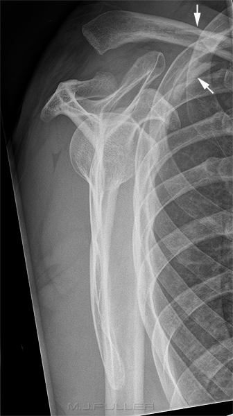dislocated AC joint