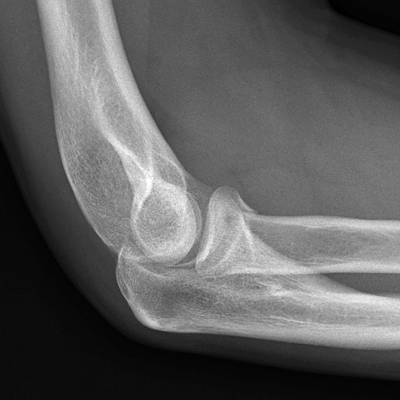 lateral elbow- radiocapitellar gap