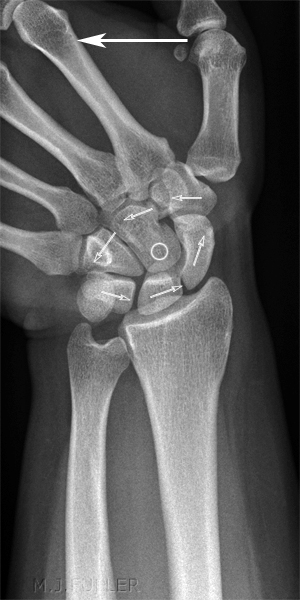 Imaging Scaphoid Fractures - wikiRadiography