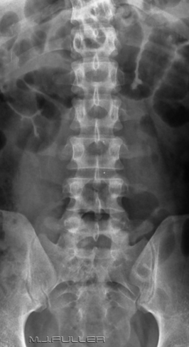 Lumbar Spine Breathing Technique - wikiRadiography