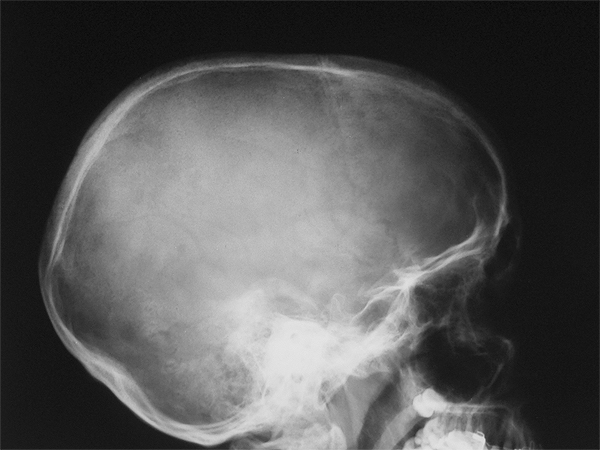 lateral skull radiograph