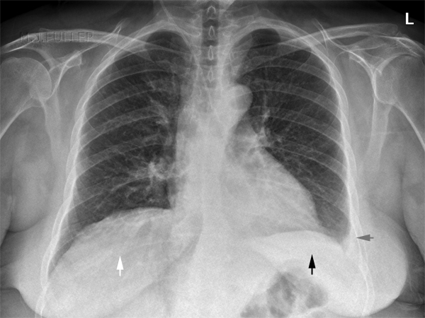 left lower lobe collapse, cons,effusion