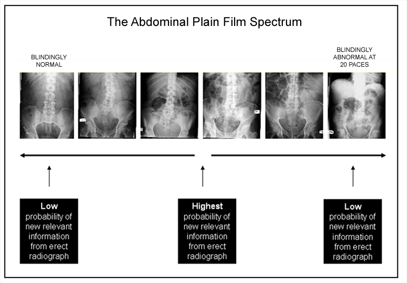 The Erect Abdominal Plain Film - wikiRadiography