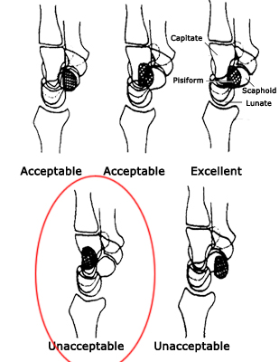 lateral wrist