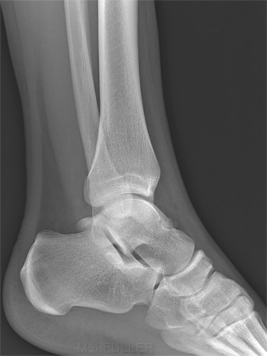 normal lateral ankle