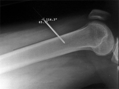 nail gun injury
