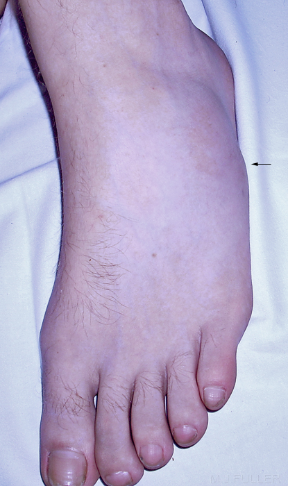 base 5th metatarsal fracture