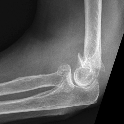 Lateral Elbow
