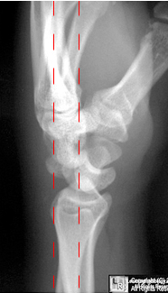 Lunate and Perilunate Dislocations - wikiRadiography