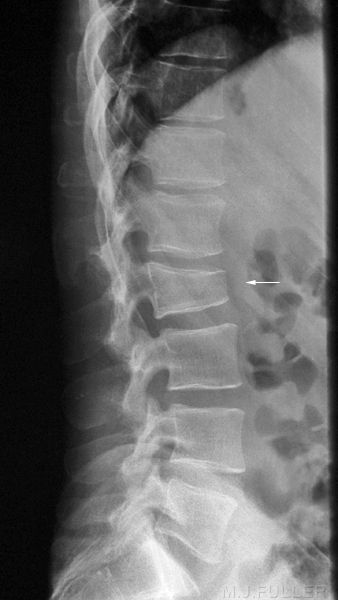 wedge fracture lumbar spine