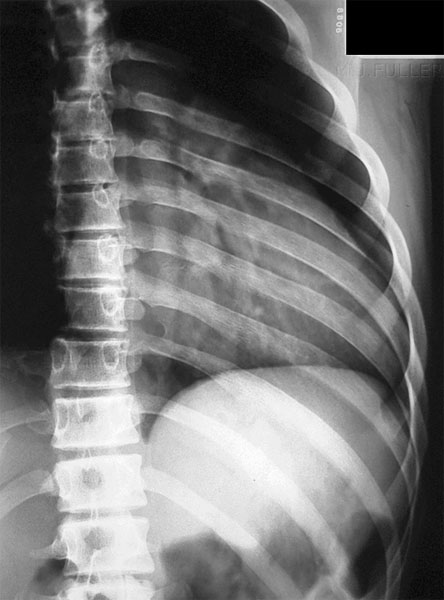 rib radiography