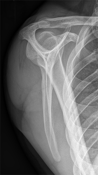 Lateral Scapula