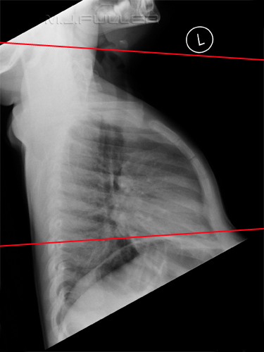 Notes on Chest Radiography - wikiRadiography