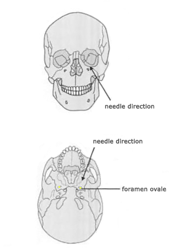 trigeminal nerve block