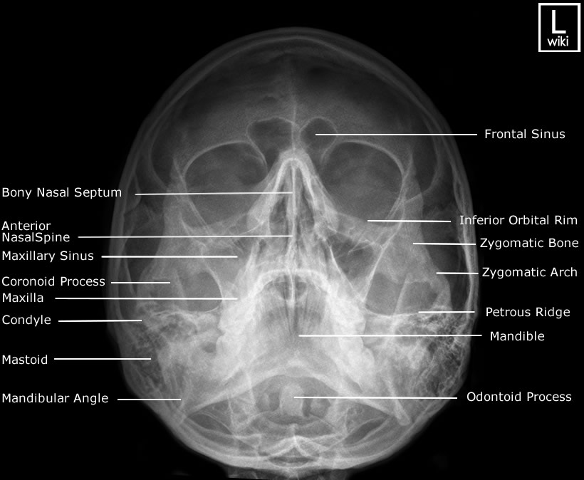 Facial Bones - Occipito Mental (OM)