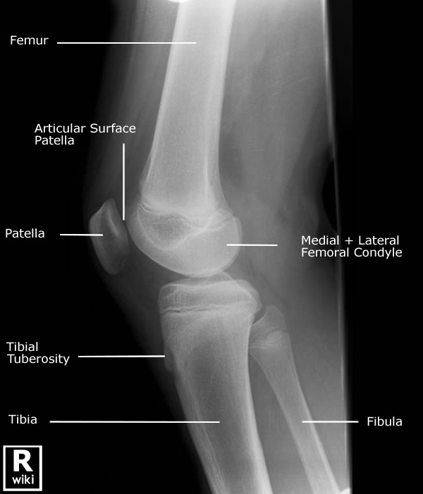 Radiographic Anatomy - Knee Lateral