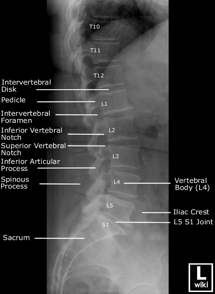 Lumbar Spine Radiographic Anatomy - wikiRadiography