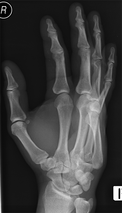 base 5th metacarpal fracture dislocation