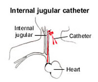 vascath - jugular insertion