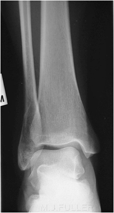 ankle fracture