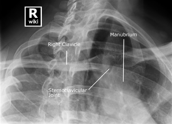 Radiographic Anatomy - Sternoclavicular Joints PA Oblique
