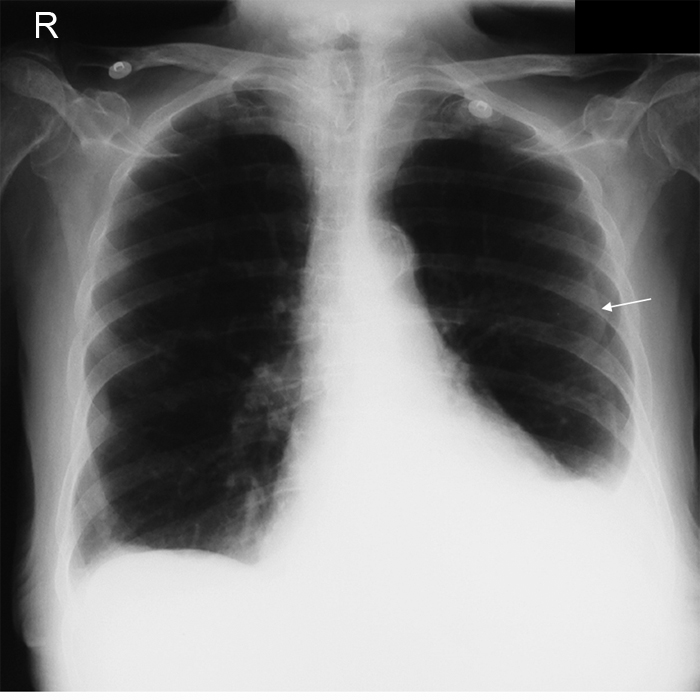 false pneumothorax from skinfold