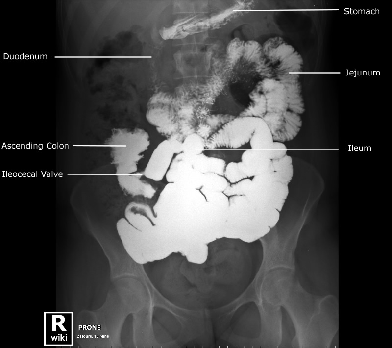 Radiographic Anatomy - Abdomen AP Supine SBS