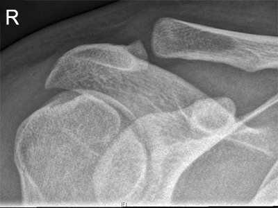 AC joint radiography
